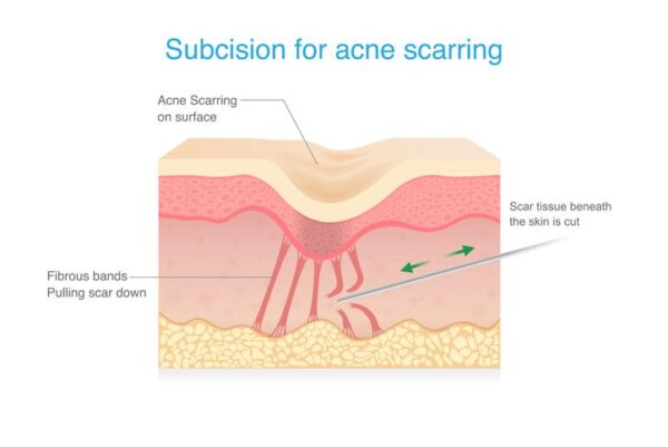 Subcision