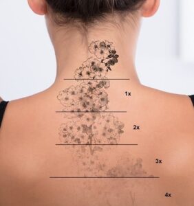 Eliminación de Tatuajes Medianos